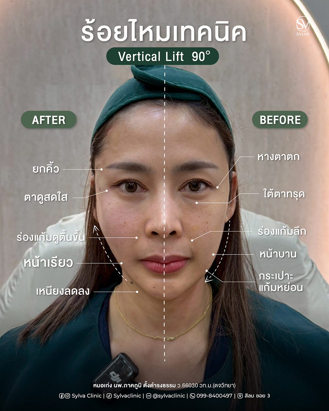 Before/After Vertical Lift 90° พร้อมจุดปัญหา
