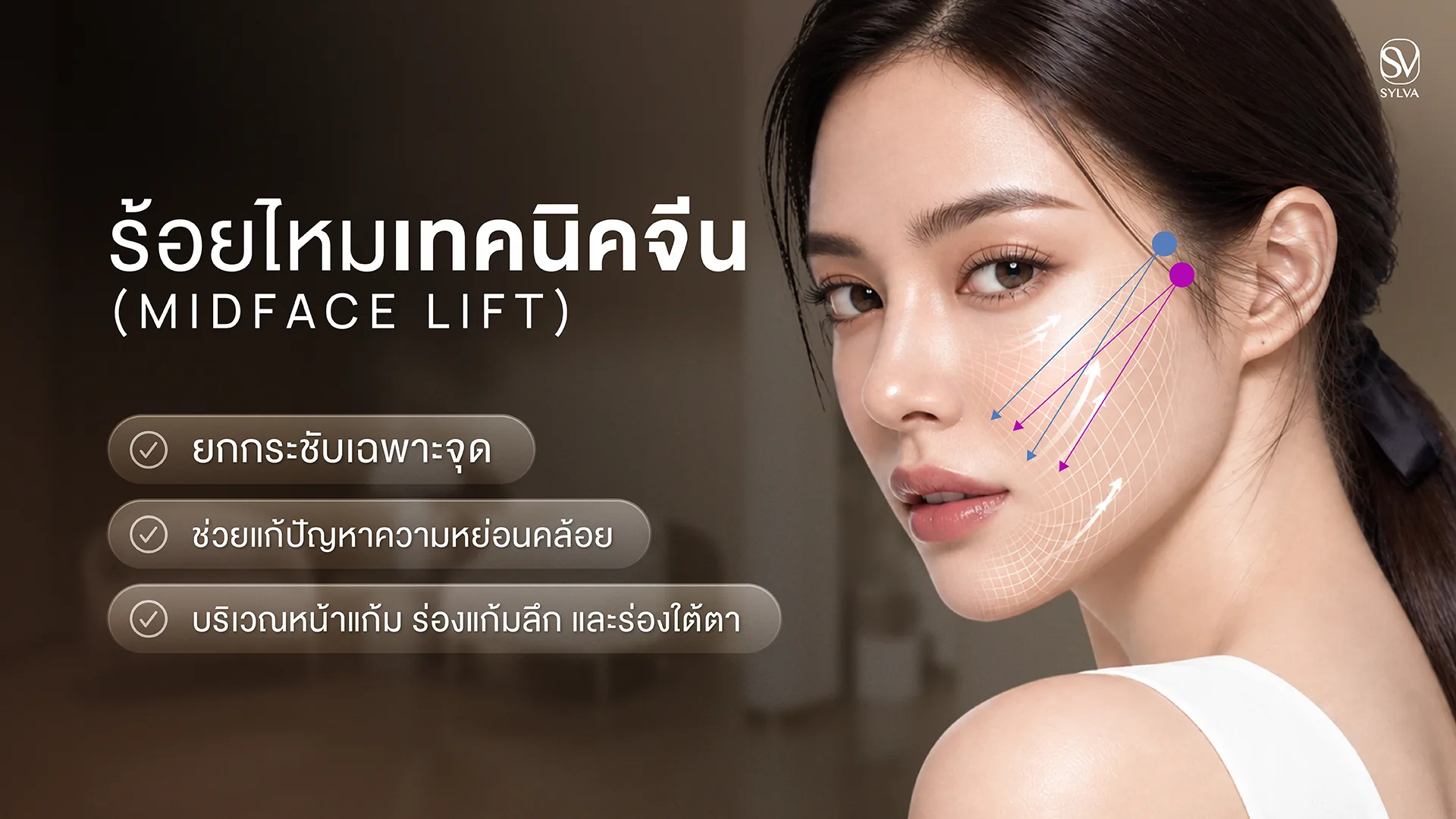 ร้อยไหมเทคนิคจีน Midface Lift ยกเนื้อเยื่อบริเวณ Mid-face ร่องแก้ม Indian Line ใต้ตา