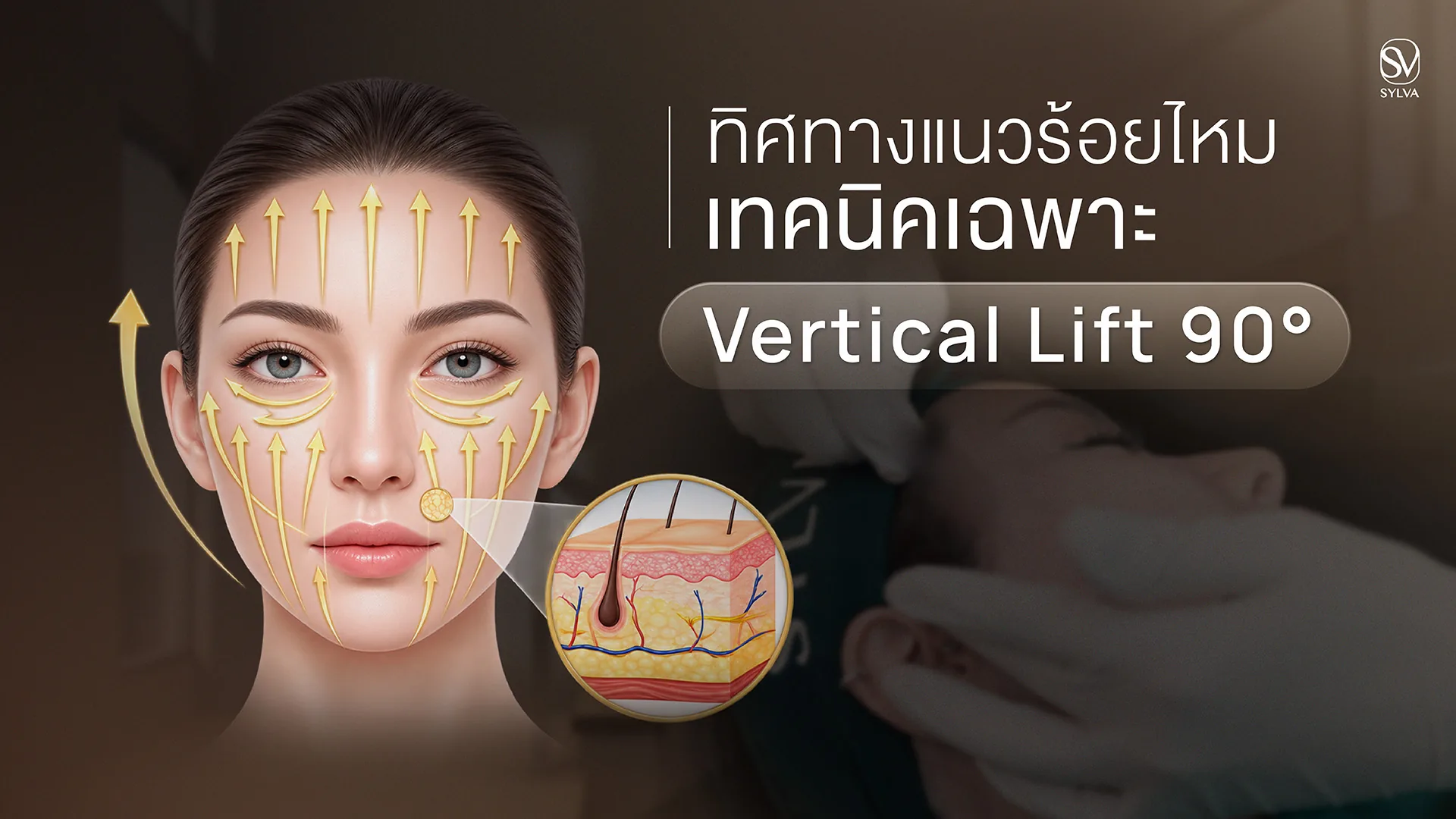 ทิศทางแนวร้อยไหมเทคนิคเฉพาะ Vertical Lift 90° ยกขึ้นในแนวตั้งหลายชั้นของใบหน้า